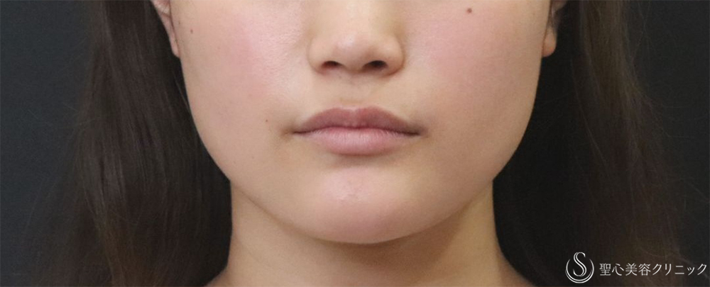 【20代女性・エラの張り】​エラボトックス（2回注射）（3ヶ月後） After 