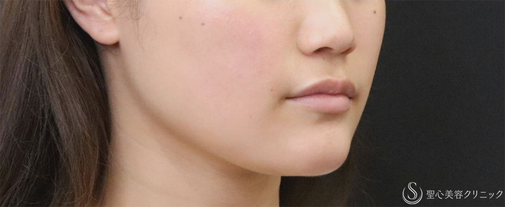【20代女性・エラの張り】​エラボトックス（2回注射）（3ヶ月後） After 