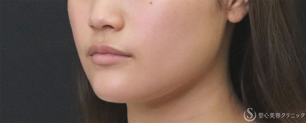 【20代女性・エラの張り】​エラボトックス（2回注射）（3ヶ月後） After 