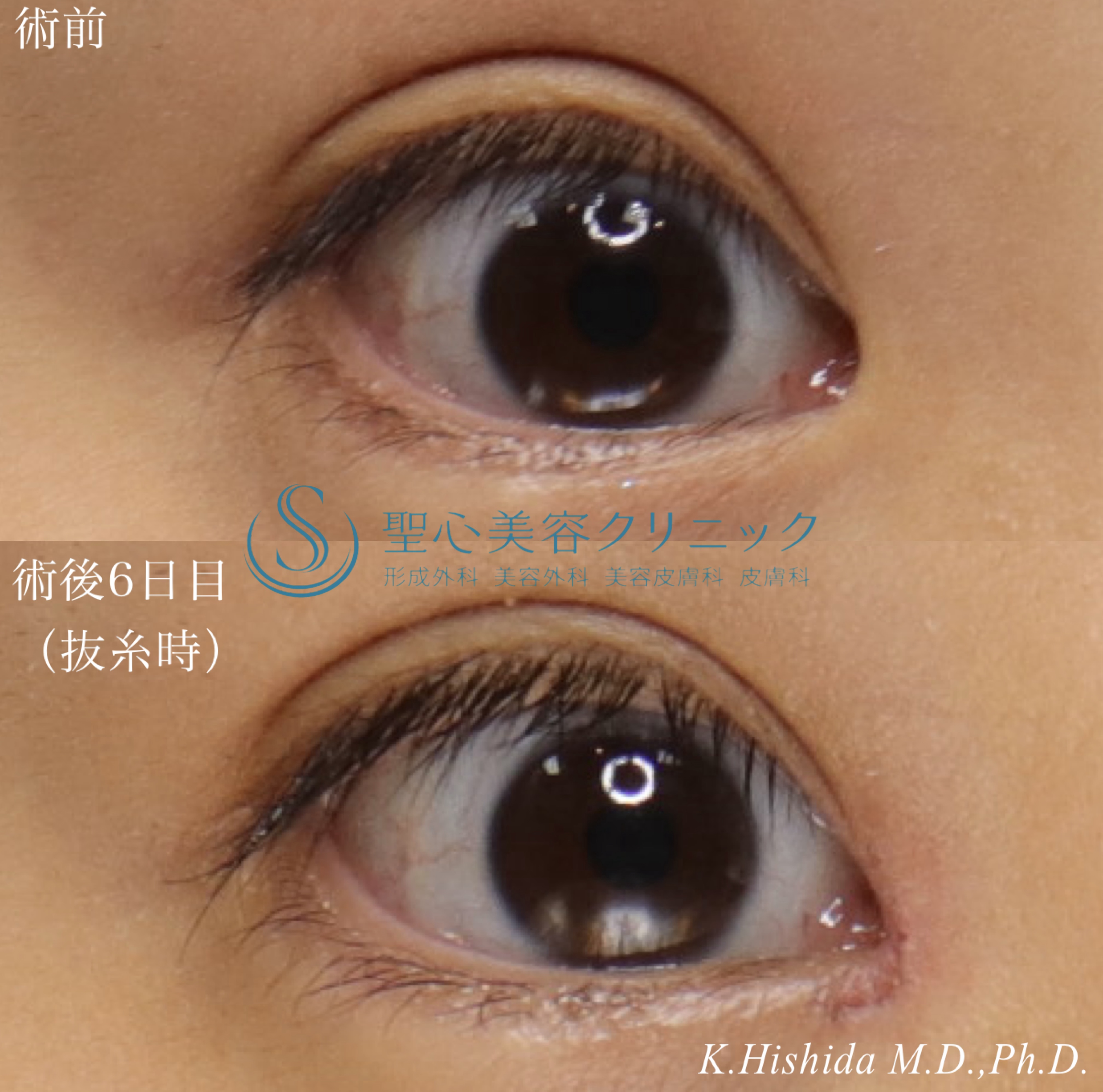 【30代女性・目頭の形を整えたい！！】目頭切開（リドレープ法）（6日後）（抜糸時） After 