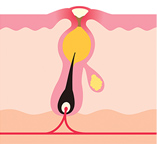 白ニキビができた皮膚、毛根の断面図