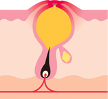 赤ニキビができた皮膚、毛根の断面図