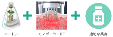 ニードル+モノポーラーRF+適切な薬剤