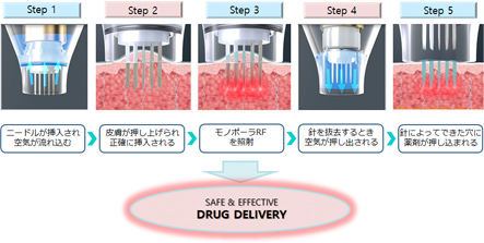 STEP1:ニードルが挿入され空気が流れ込む STEP2:皮膚が押し上げられ正確に挿入される STEP3:モノポーラRFを照射 STEP4:針を除去するとき空気が押し出される STEP5:針によってできた穴に薬剤が押し込まれる→SAFE & EFFECTIVE DRYG DELIVERY