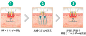 1.RFエネルギー照射→2.皮膚の抵抗を測定→3.即座に調整＆最適なエネルギーを照射