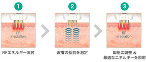 1 RFエネルギー照射 2 皮膚の抵抗を測定 3 即座に調整&最適なエネルギーを照射