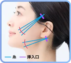 マリオネットラインを引き上げたい場合