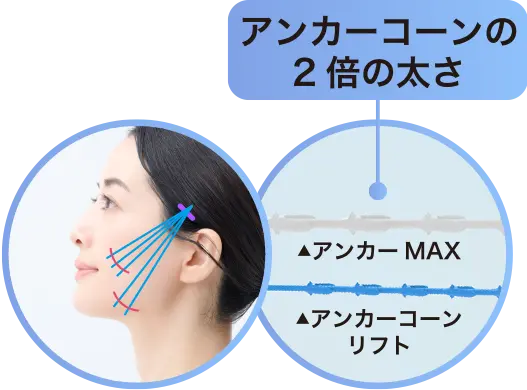 アンカーコーンの2倍の太さの図