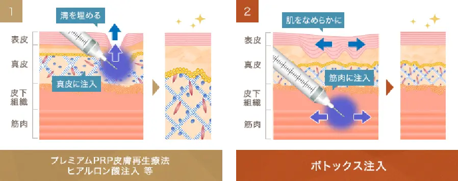 1 プレミアムPRP皮膚再生療法 ヒアルロン酸注入 等 の図 2 ボトックス注入 の図