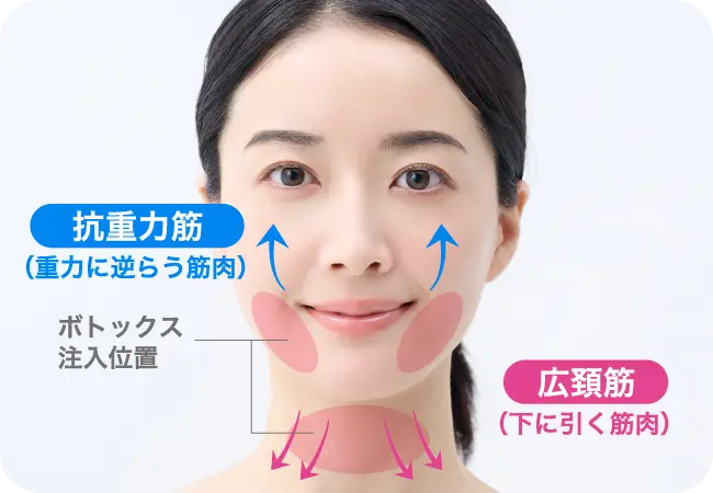 ボトックスリフト