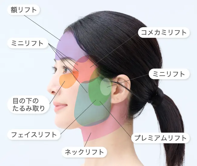 フェイスリフトとは