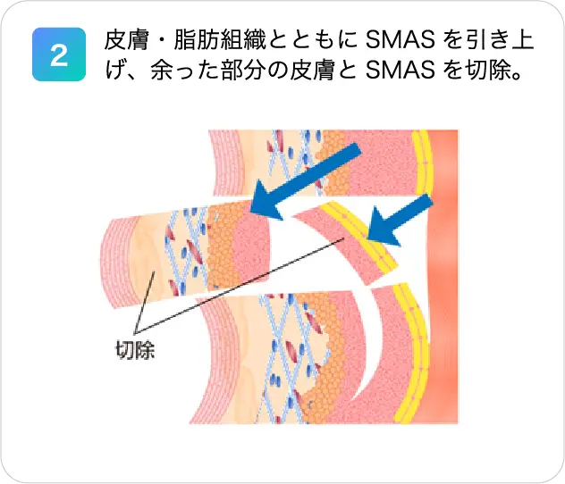 2.皮膚・脂肪組織とともにSMASを引き上げ、余った部分の皮膚とSMASを切除。