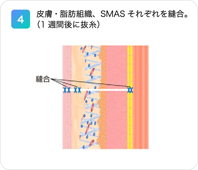 4.皮膚・脂肪組織、SMASそれぞれを縫合。（1週間後に抜糸）