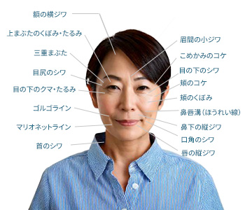 目の下のシワ、頬のくぼみ、口角のシワ、唇の縦ジワ、鼻唇溝（ほうれい線）