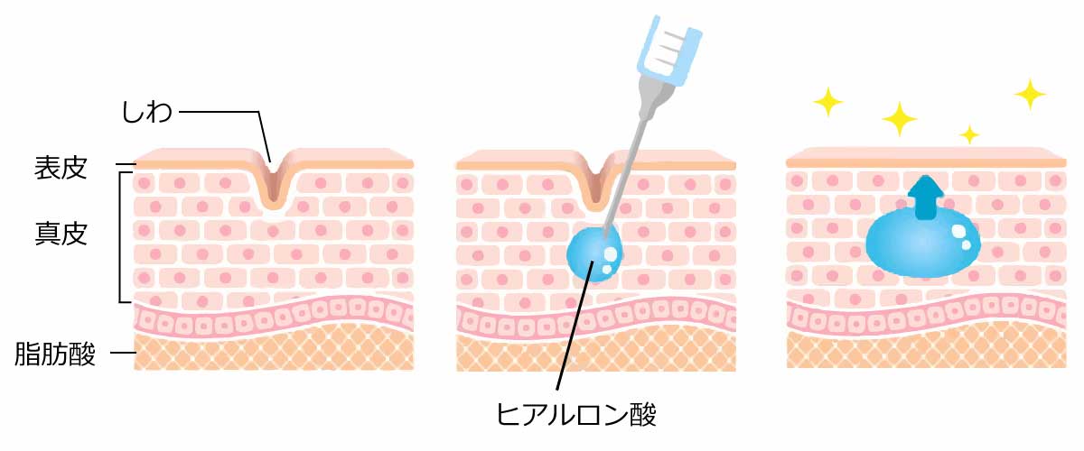 ヒアルロン酸注射（注入）とは