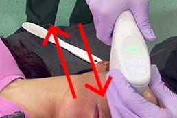 往復照射が可能になり、施術時間がさらに短くなりました