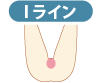 Iライン