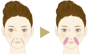 頬の膨らみ等の周りのバランス(面)を考慮して、注入していきます。