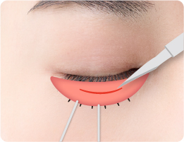 結膜部分の切開