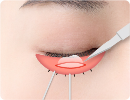 結膜部分の切開