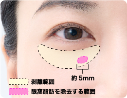 剥離範囲 眼窩脂肪を除去する範囲