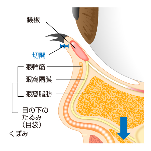 下まつげのすぐ下を切開し、眼窩隔膜より下方にはみ出してくる分だけ眼窩脂肪を切除します。 目の下のくぼみを埋めるように眼窩隔膜と脂肪を移動します