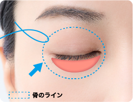 次に、眼輪筋肉を目尻の方へ吊り上げて張りを出し、頬骨の骨膜に固定します