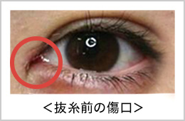 目頭切開｜縫合