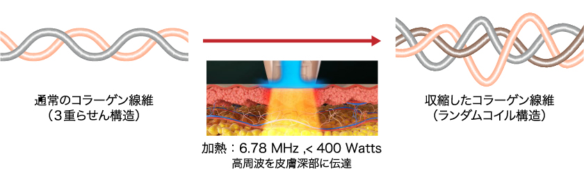 DENSITY（デンシティ）のメカニズム