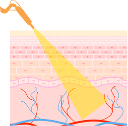 POTENZA（ポテンツァ）_照射
