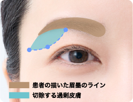 患者の書いた眉墨のライン・切除する余剰皮膚