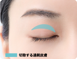 切除する余剰皮膚