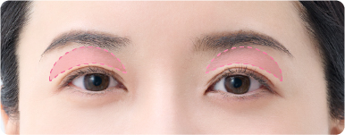 目の上のたるみ