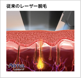 熱破壊式レーザー脱毛