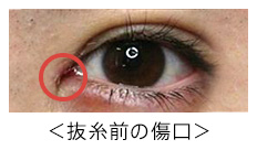 目頭切開｜傷跡も気にならない