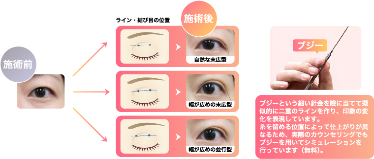 自然な末広型、幅が広めの末広型、幅が広めの平行型。上記の写真は、ブジーという細い針金を瞼に当てて疑似的に二重のラインを作り、印象の変化を表現しています。糸を留める位置によって仕上がりが異なるため、実際のカウンセリングでもブジーを用いてシミュレーションを行っています（無料）。
