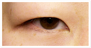 分厚い瞼（まぶた）