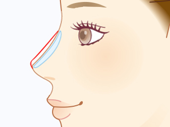 プロテーゼ入れ替え・取り出し