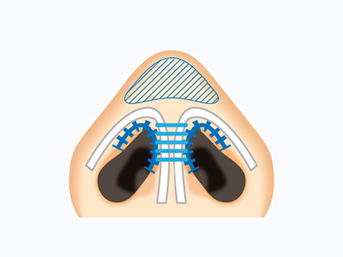 鼻尖形成（3DPCLドーム）