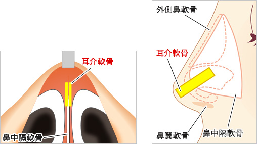 ③肋軟骨/耳介軟骨（もしくは両方の軟骨）で支柱を立てる