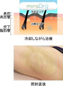 冷却しながら治療 照射直後