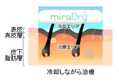 ミラドライ_クーリング