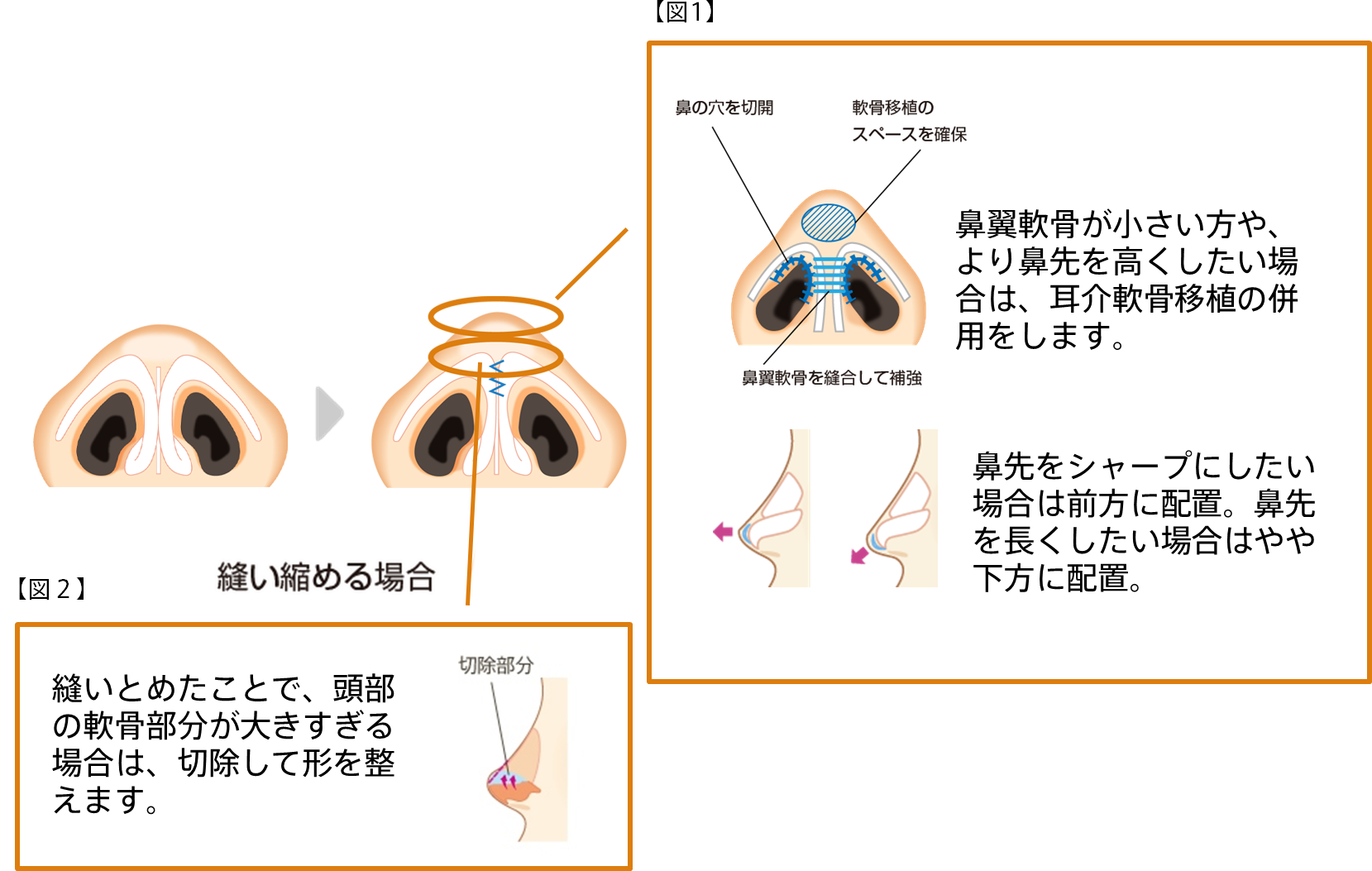 当院の鼻尖縮小