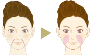 頬の膨らみ等の周りのバランス(面)を考慮して、注入していきます。