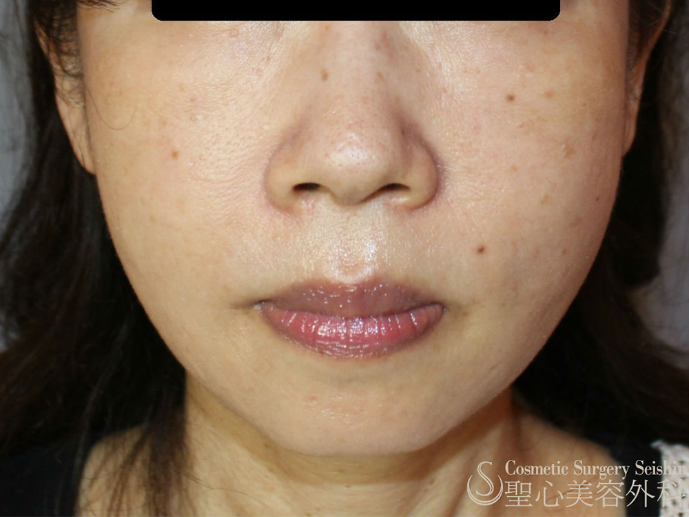 プレミアムディメンショナルリフト_After