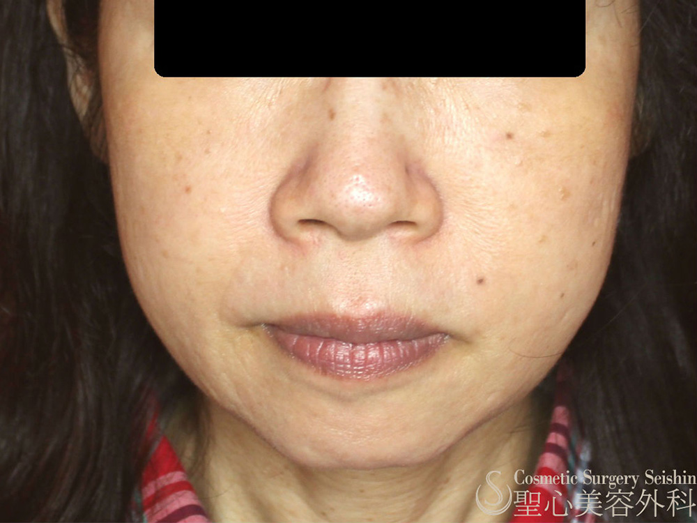 プレミアムディメンショナルリフト_Before