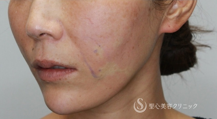 アンカーPlus_After