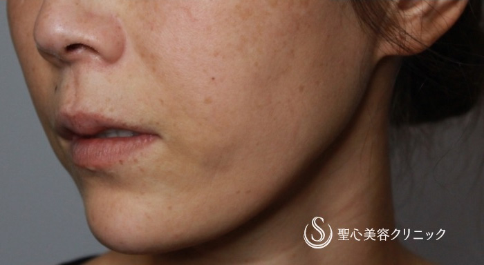 アンカーPlus_Before