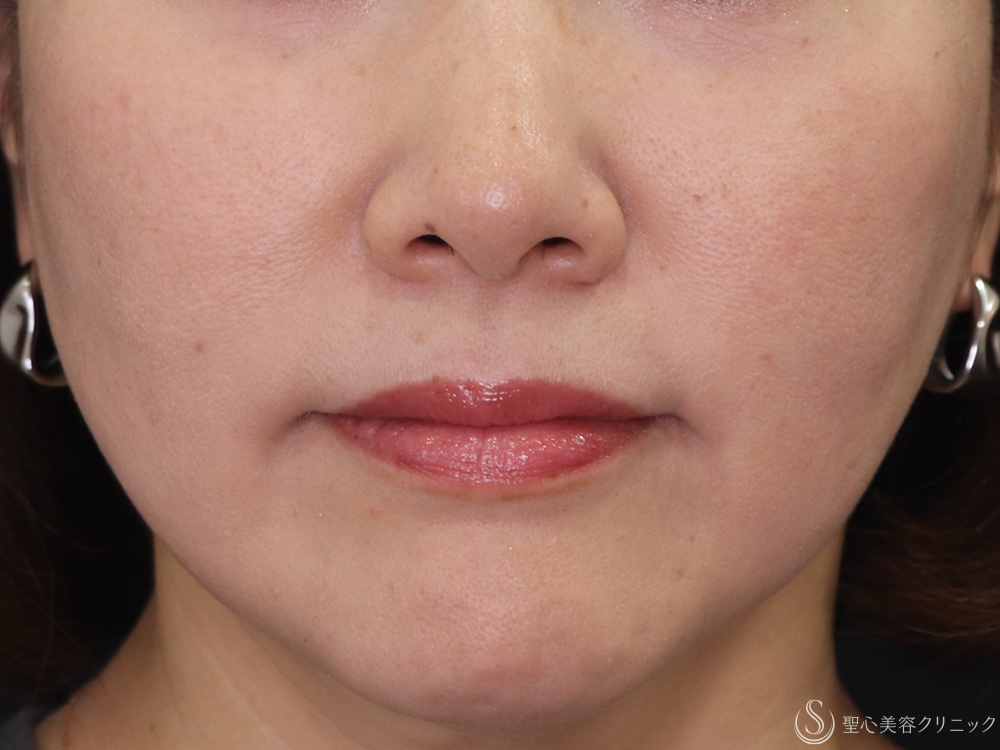 アンカーPlus_After