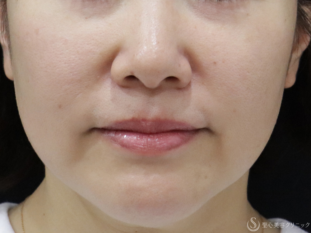 アンカーPlus_Before